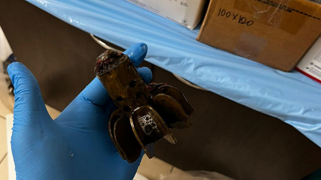Українські військові лікарі дістали хвостовик міни з тіла військовослужбовця (ФОТО)